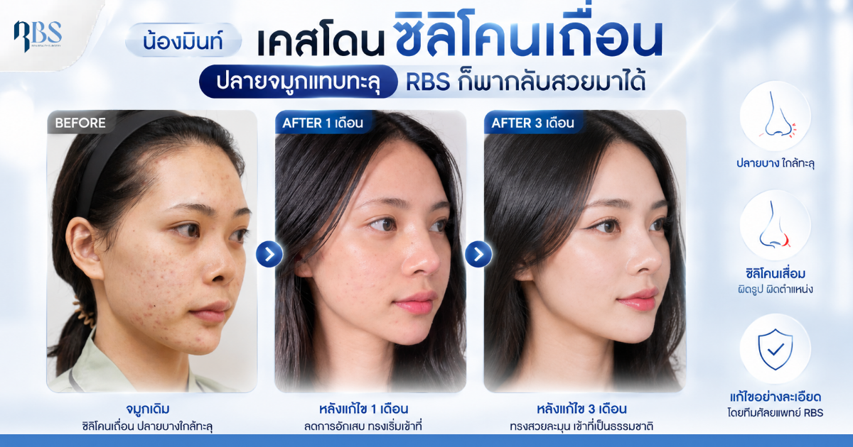 น้องมิ้นท์…เข็ดแล้วกับซิลิโคนเถื่อน