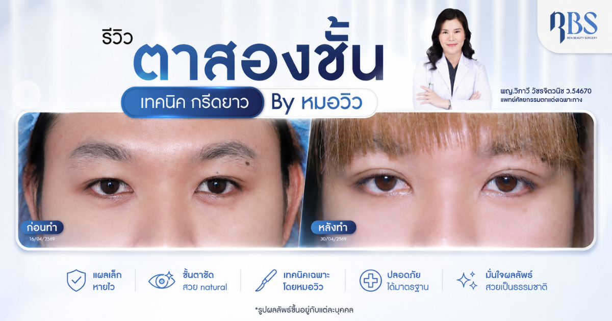 รีวิวตาสองชั้น เทคนิคกรีดยาว ครบ 14 วัน By หมอวิว RBS Clinic